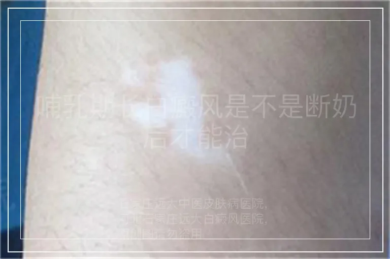 哺乳期长白癜风是不是断奶后才能治