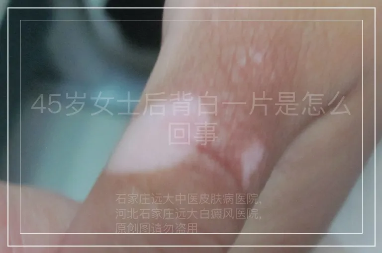 45岁女士后背白一片是怎么回事