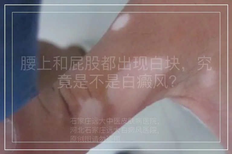 腰上和屁股都出现白块，究竟是不是白癜风？