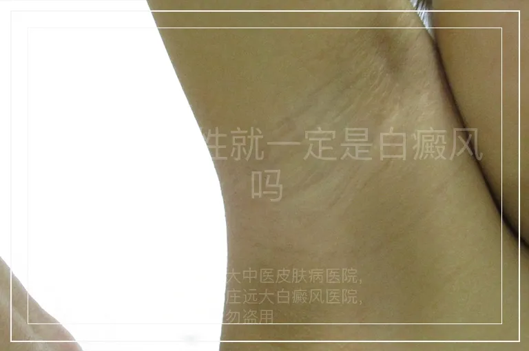 伍德灯阳性就一定是白癜风吗
