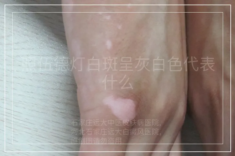 照伍德灯白斑呈灰白色代表什么