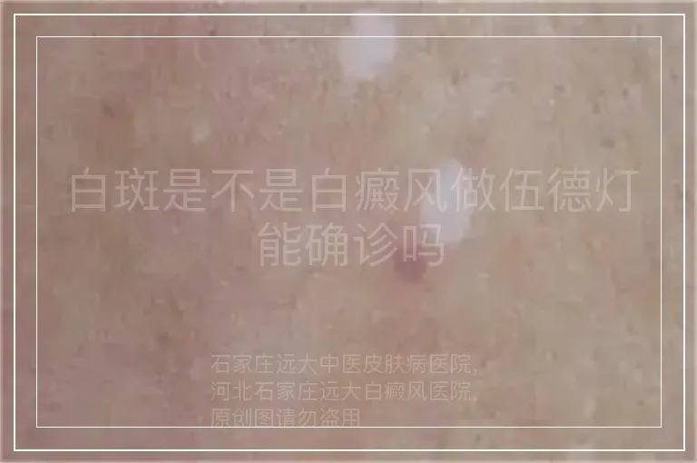 白斑是不是白癜风做伍德灯能确诊吗
