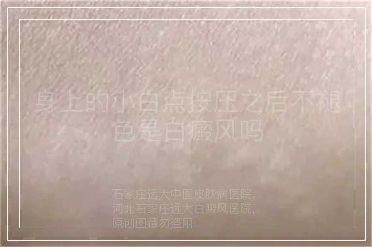 身上的小白点按压之后不褪色是白癜风吗