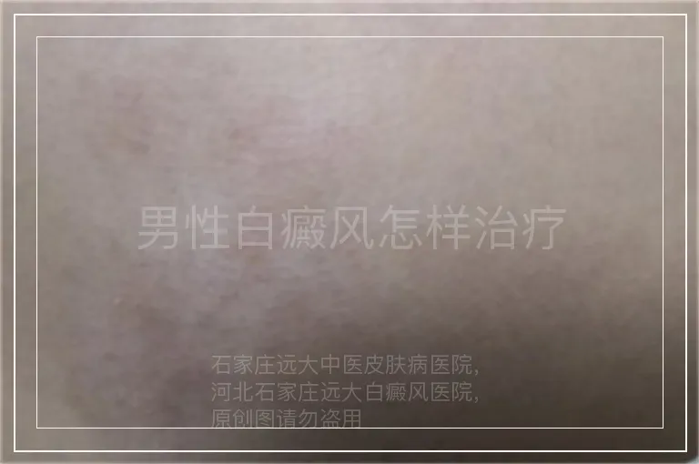 男性白癜风怎样治疗