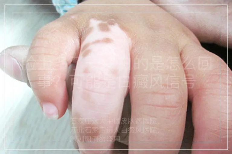 脸上多了一块白的是怎么回事?可能是白癜风信号