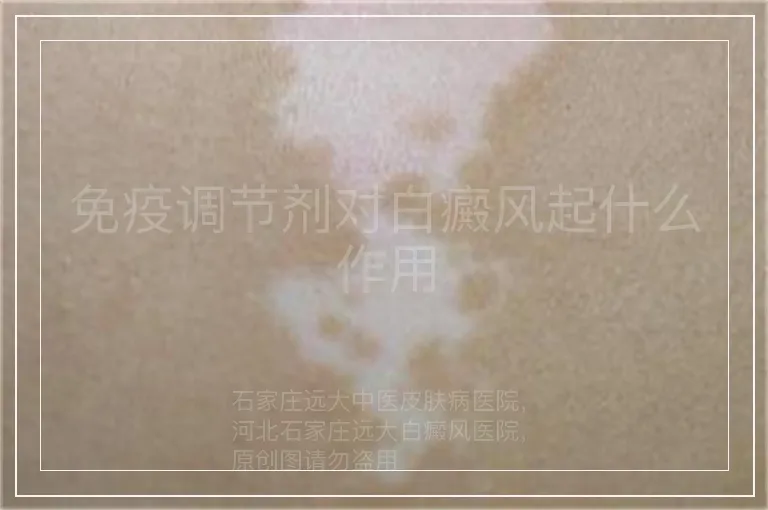 免疫调节剂对白癜风起什么作用