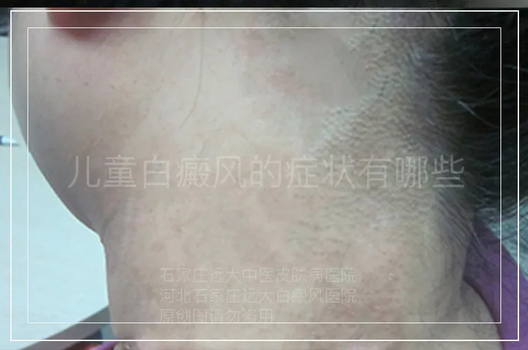 儿童白癜风的症状有哪些