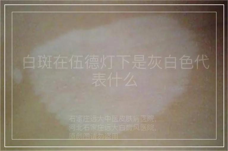 白斑在伍德灯下是灰白色代表什么