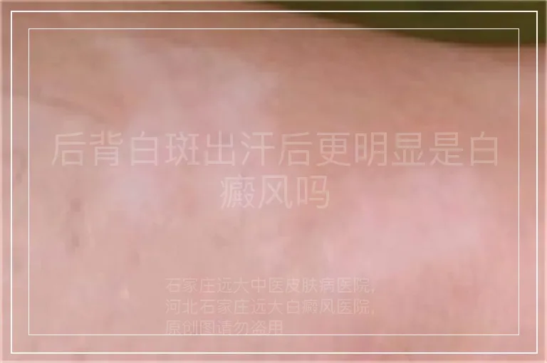 后背白斑出汗后更明显是白癜风吗