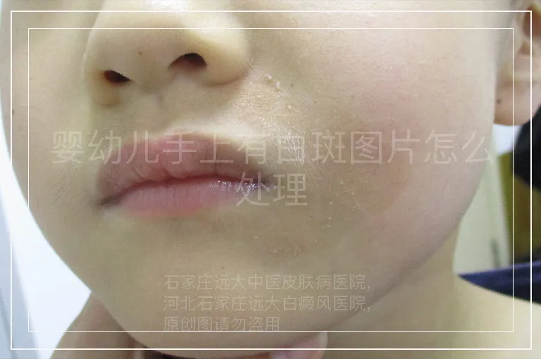 婴幼儿手上有白斑图片怎么处理