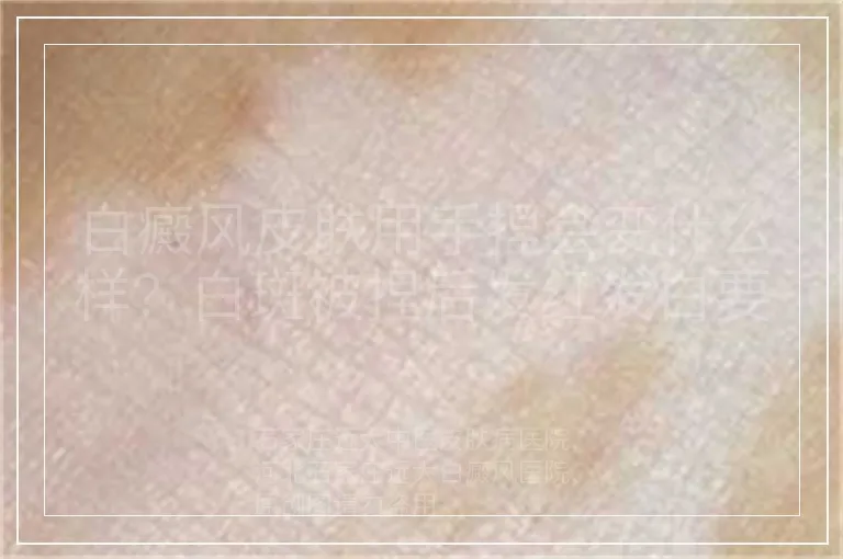 白癜风皮肤用手捏会变什么样？白斑被捏后发红发白要分清