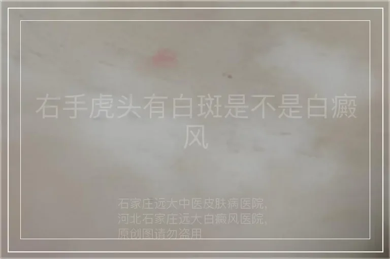 右手虎头有白斑是不是白癜风