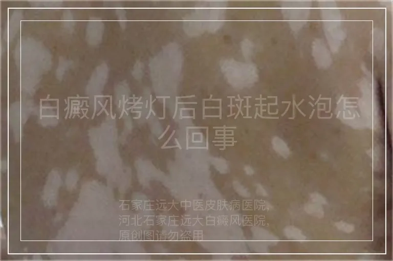 白癜风烤灯后白斑起水泡怎么回事