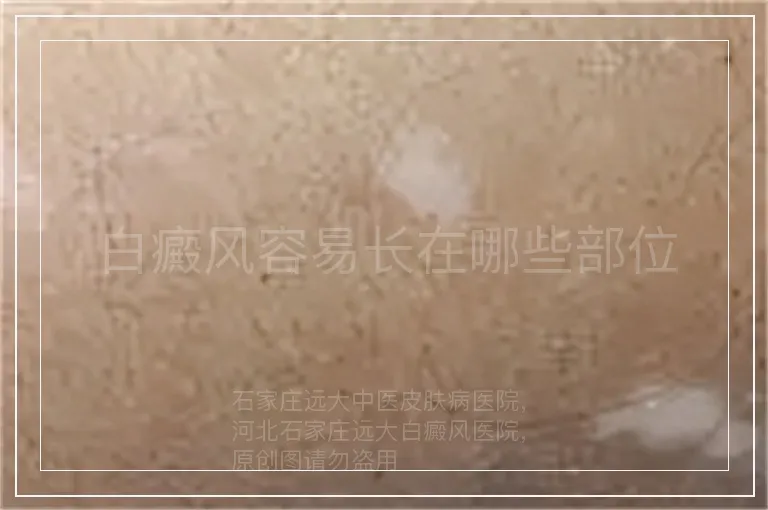白癜风容易长在哪些部位