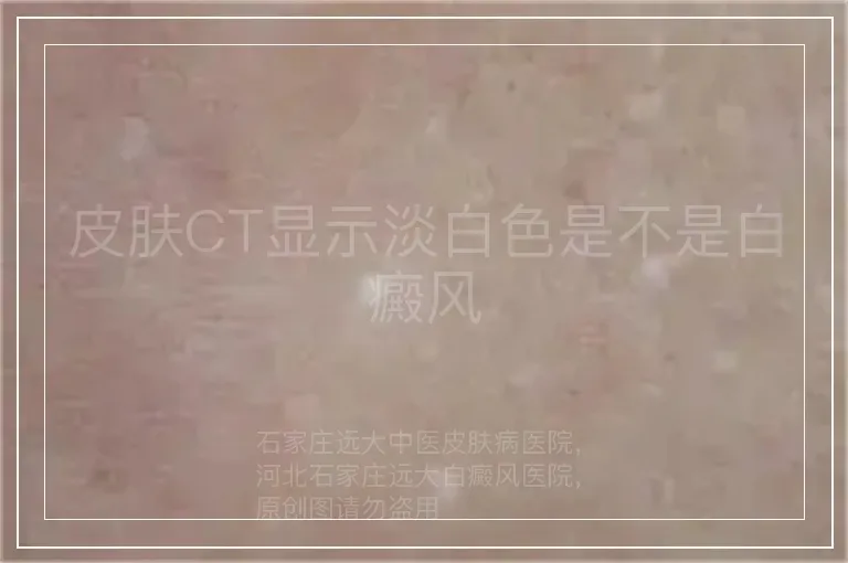 皮肤CT显示淡白色是不是白癜风