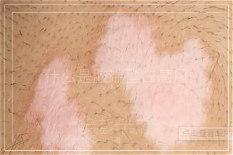 什么是肢端型白癜风