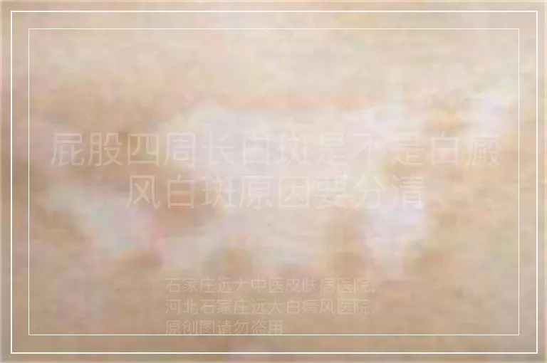 屁股四周长白斑是不是白癜风白斑原因要分清