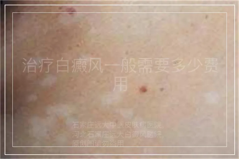 治疗白癜风一般需要多少费用
