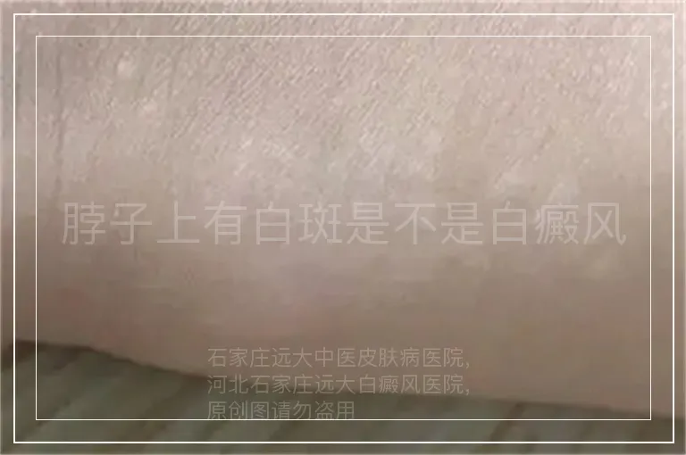 脖子上有白斑是不是白癜风