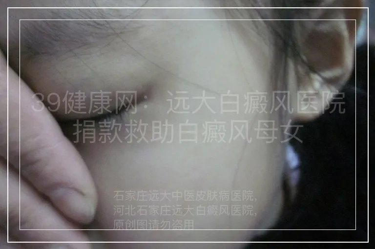 39健康网：远大白癜风医院捐款救助白癜风母女