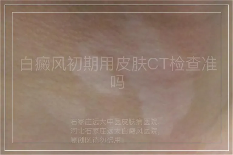 白癜风初期用皮肤CT检查准吗