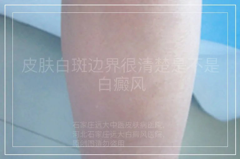 皮肤白斑边界很清楚是不是白癜风