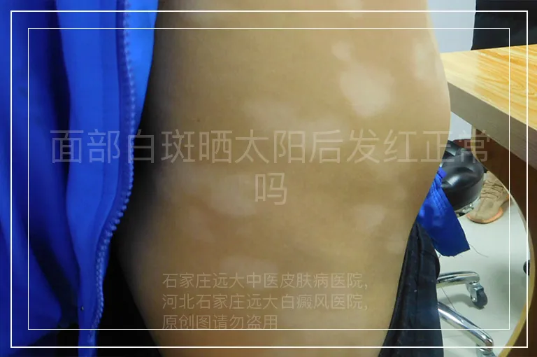 面部白斑晒太阳后发红正常吗