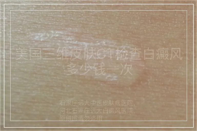 美国三维皮肤CT检查白癜风多少钱一次