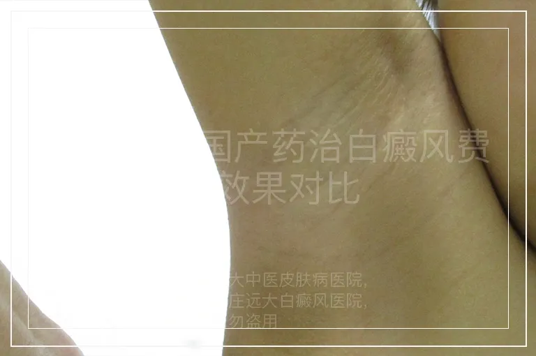 进口药与国产药治白癜风费用效果对比