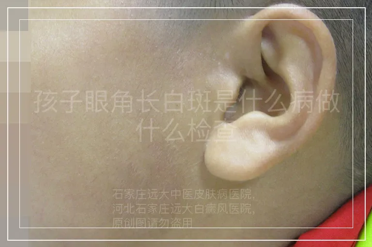 孩子眼角长白斑是什么病做什么检查
