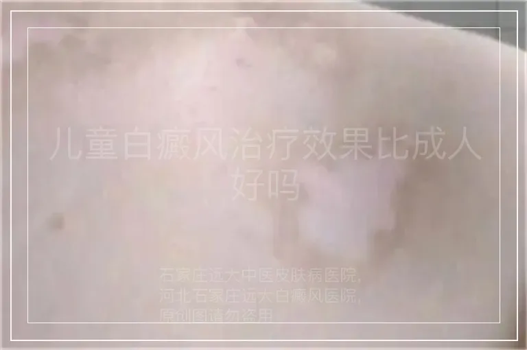 儿童白癜风治疗效果比成人好吗