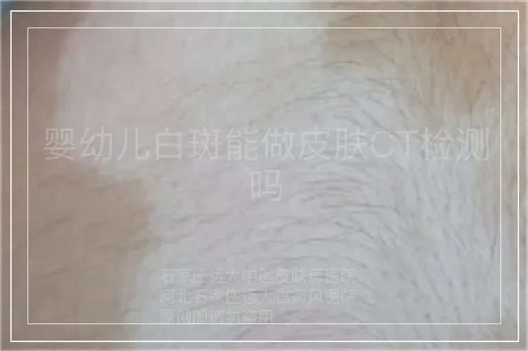 婴幼儿白斑能做皮肤CT检测吗