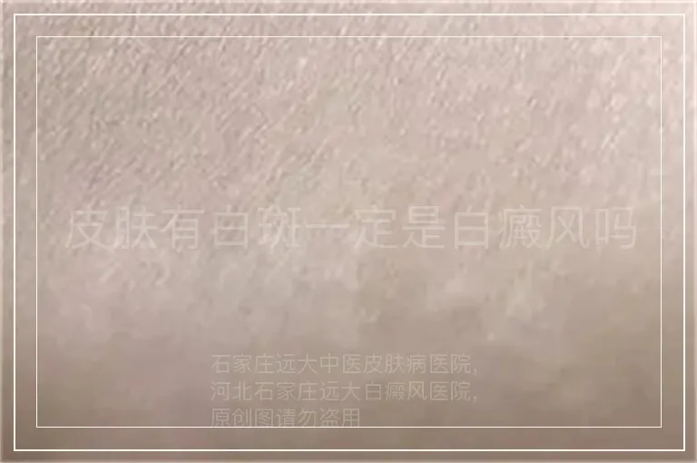 皮肤有白斑一定是白癜风吗