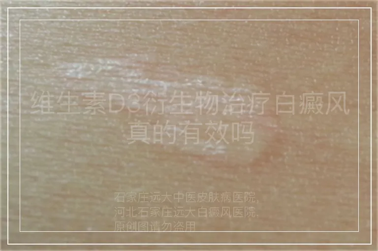 维生素D3衍生物治疗白癜风真的有效吗