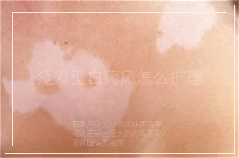 泛发型白癜风怎么护理