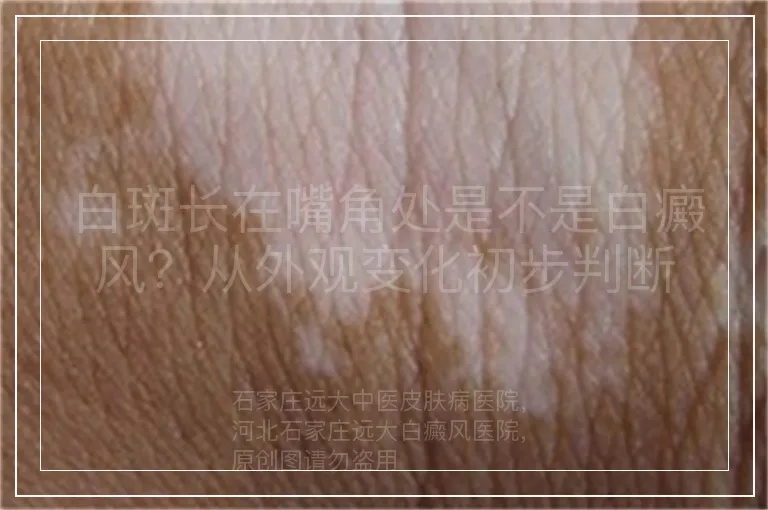 白斑长在嘴角处是不是白癜风？从外观变化初步判断