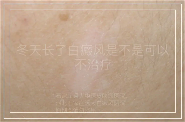 冬天长了白癜风是不是可以不治疗