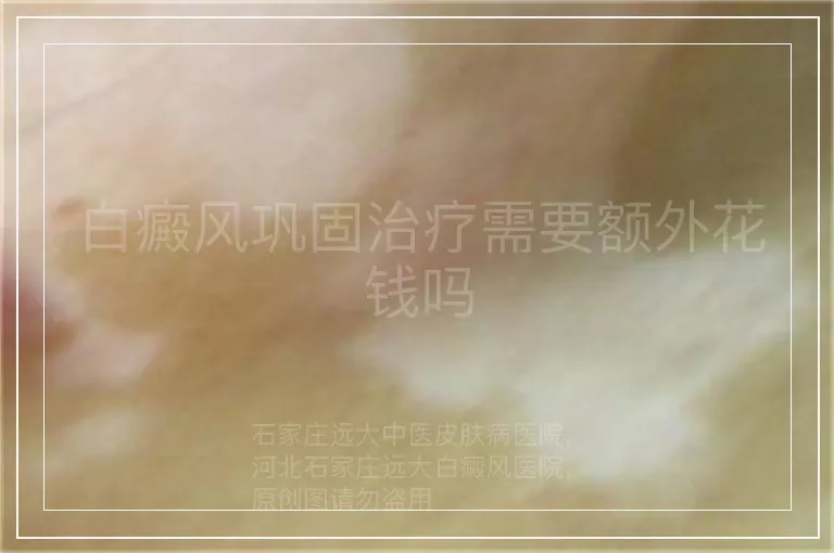 白癜风巩固治疗需要额外花钱吗