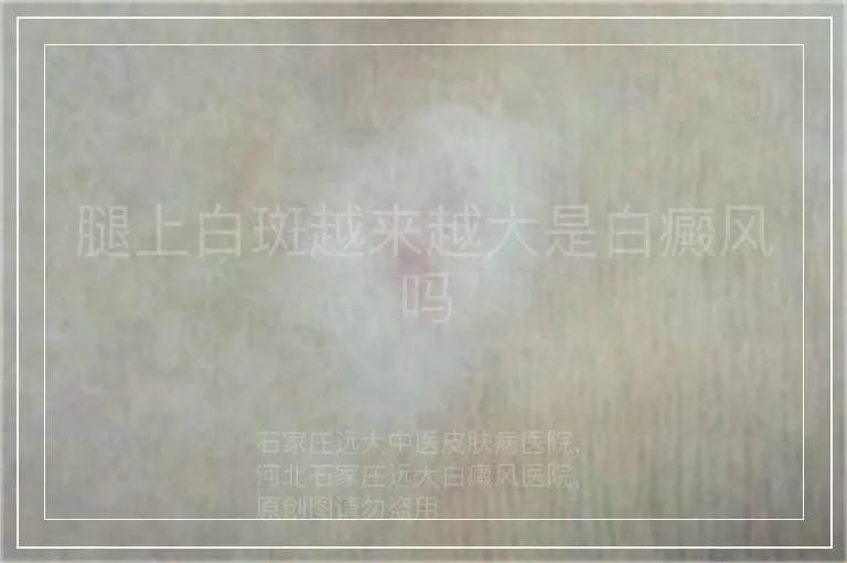 腿上白斑越来越大是白癜风吗