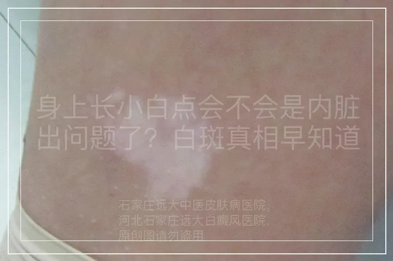 身上长小白点会不会是内脏出问题了？白斑真相早知道