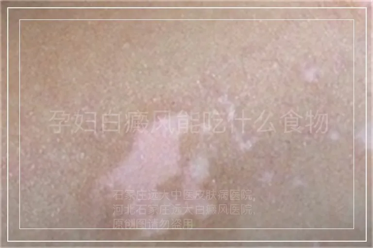 孕妇白癜风能吃什么食物