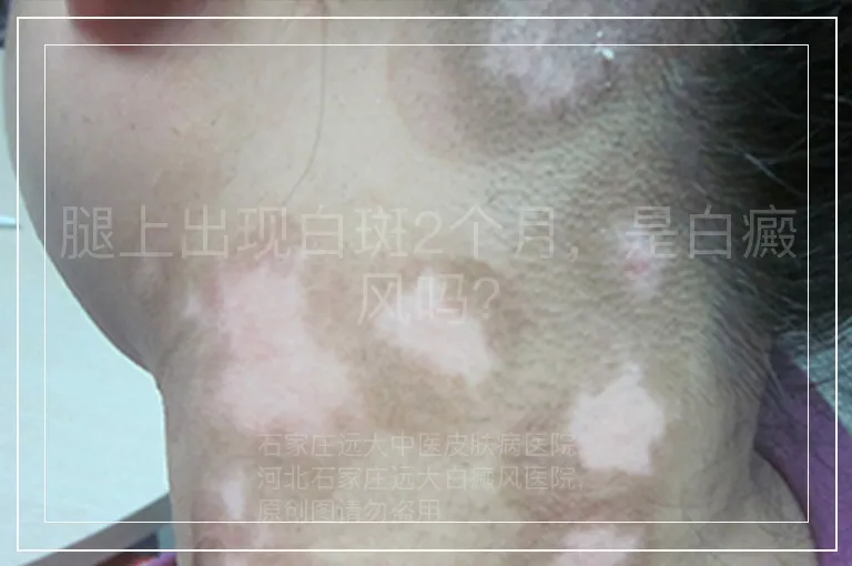 腿上出现白斑2个月，是白癜风吗？