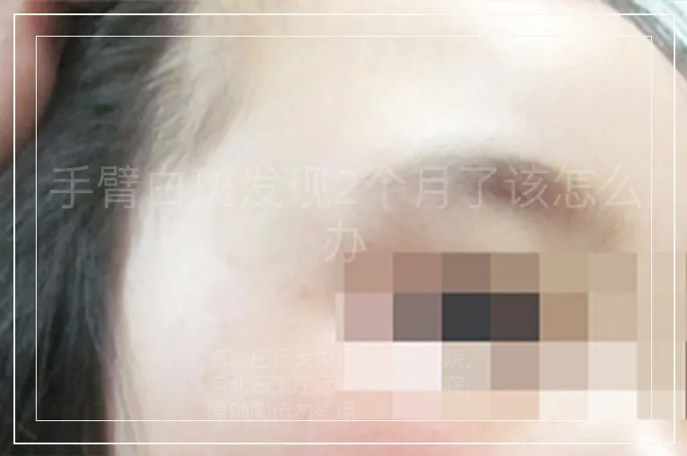 手臂白斑发现2个月了该怎么办