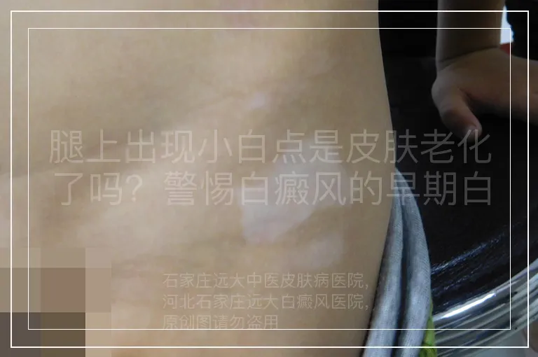 腿上出现小白点是皮肤老化了吗？警惕白癜风的早期白斑