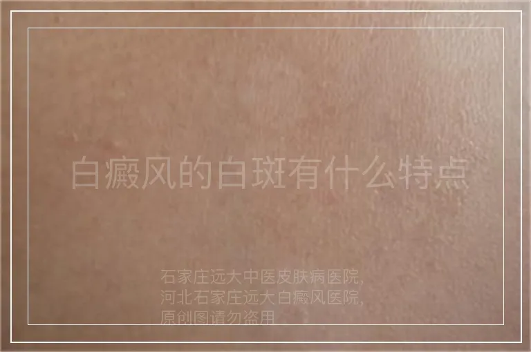 白癜风的白斑有什么特点