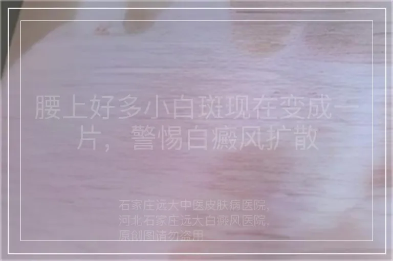 腰上好多小白斑现在变成一片，警惕白癜风扩散