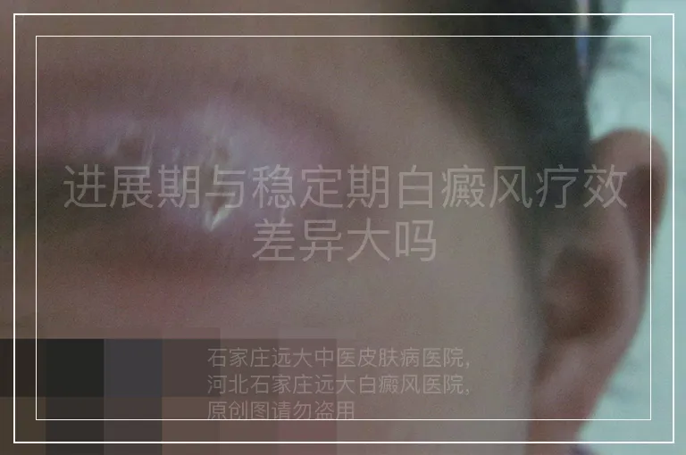 进展期与稳定期白癜风疗效差异大吗
