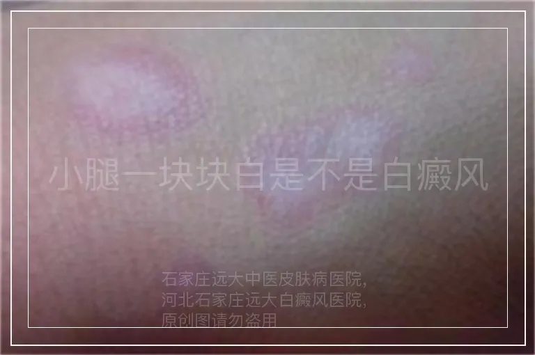 小腿一块块白是不是白癜风