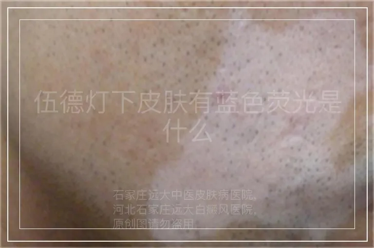 伍德灯下皮肤有蓝色荧光是什么