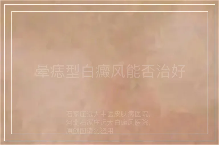 晕痣型白癜风能否治好